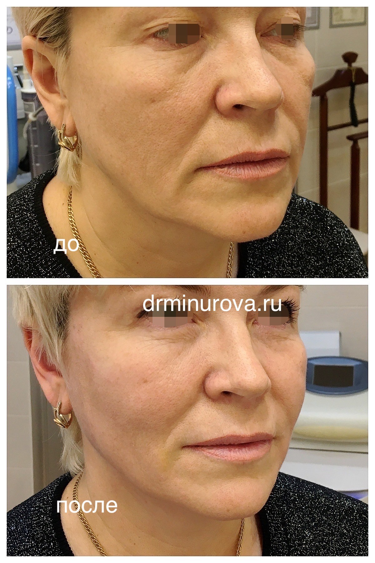 коррекция птоза кожи лица нитями